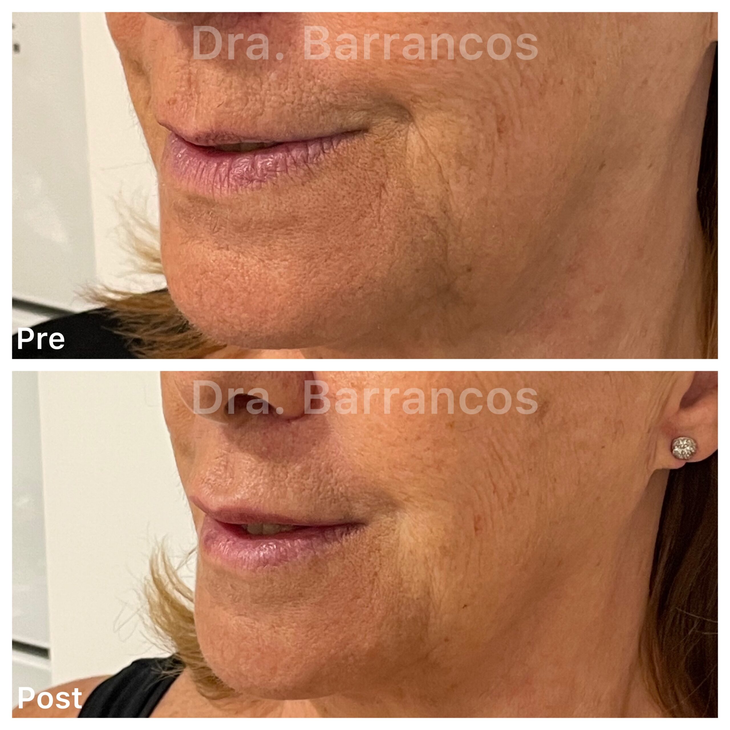 Relleno de tercio inferior y labios