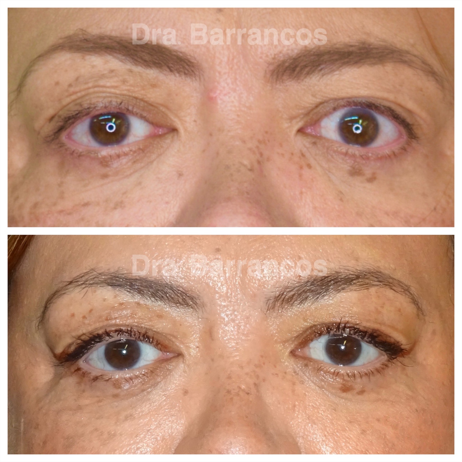 Correction of left upper eyelid retraction.