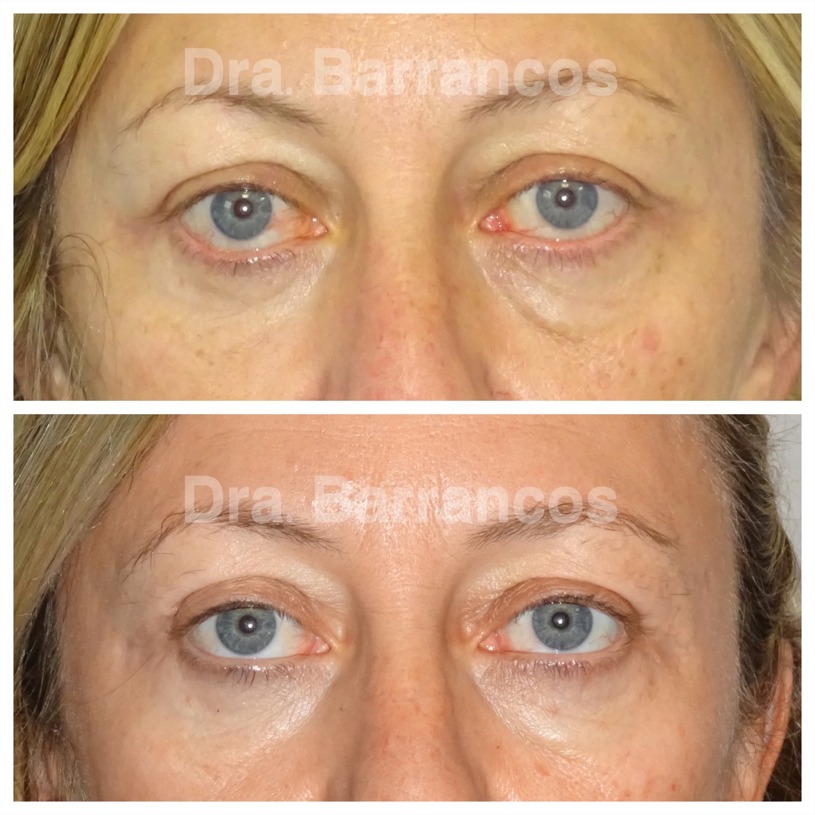 Correction of lower eyelid retraction