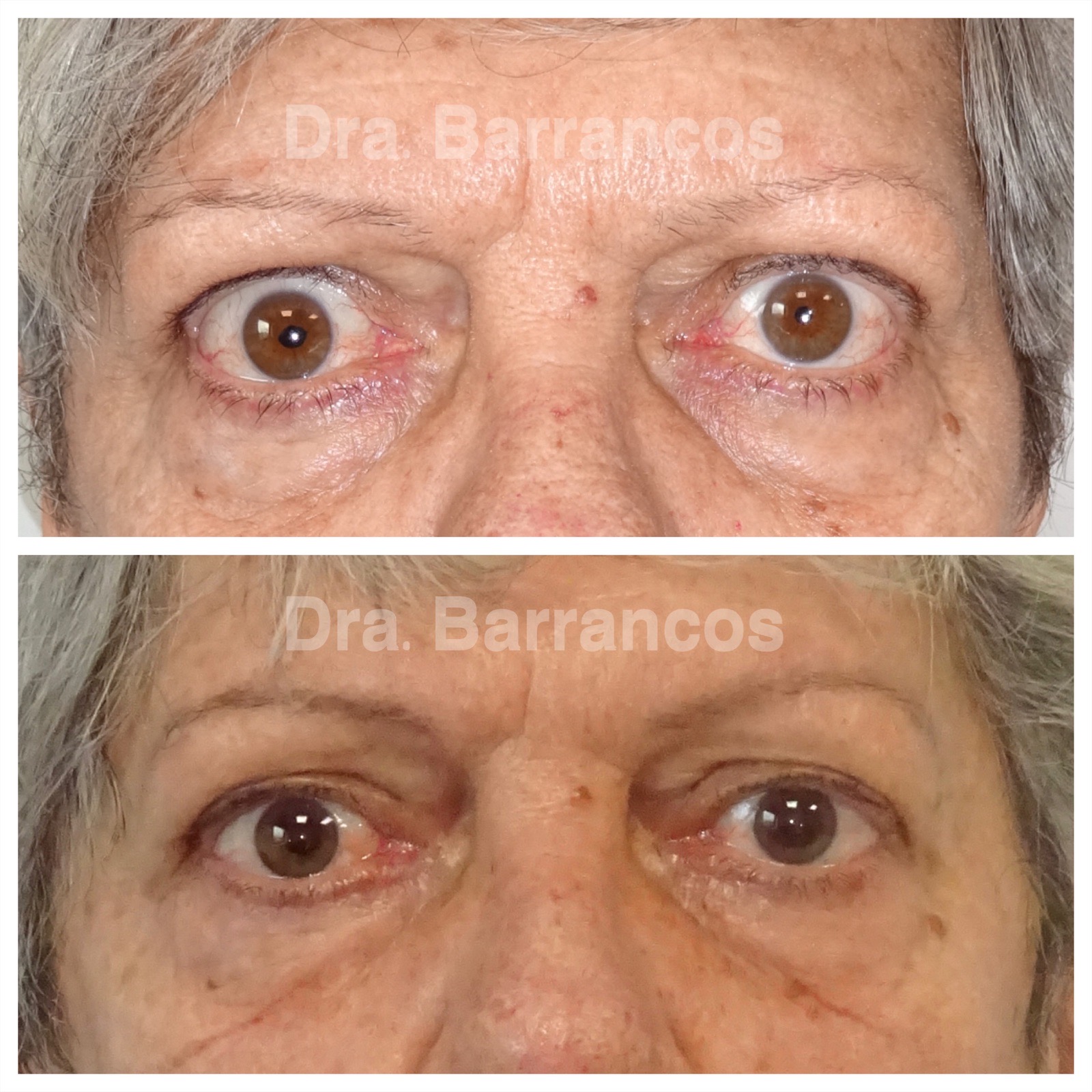 Correction of eyelid retraction in thyroid orbitopathy