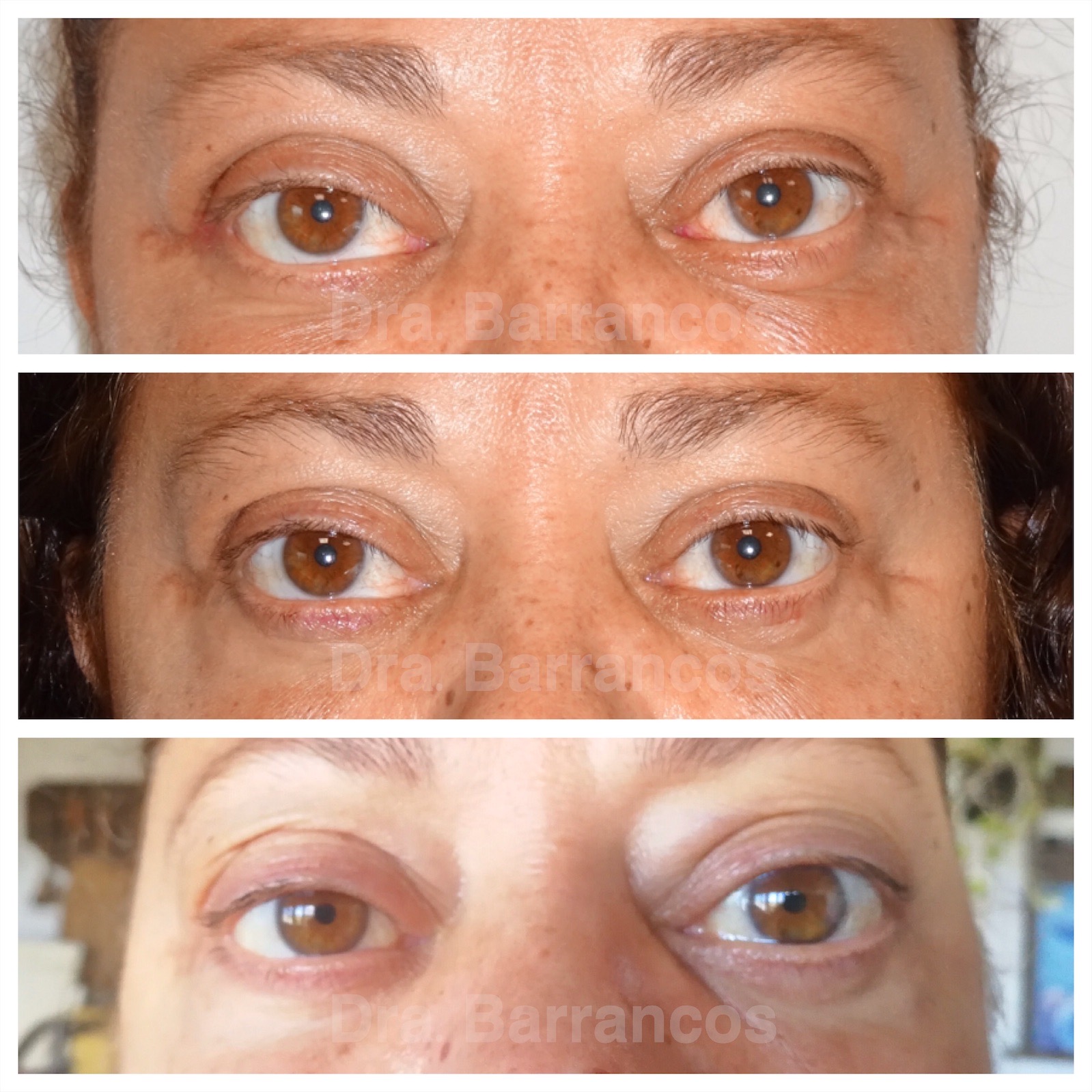 Correction of lower eyelid retraction with palatal graft