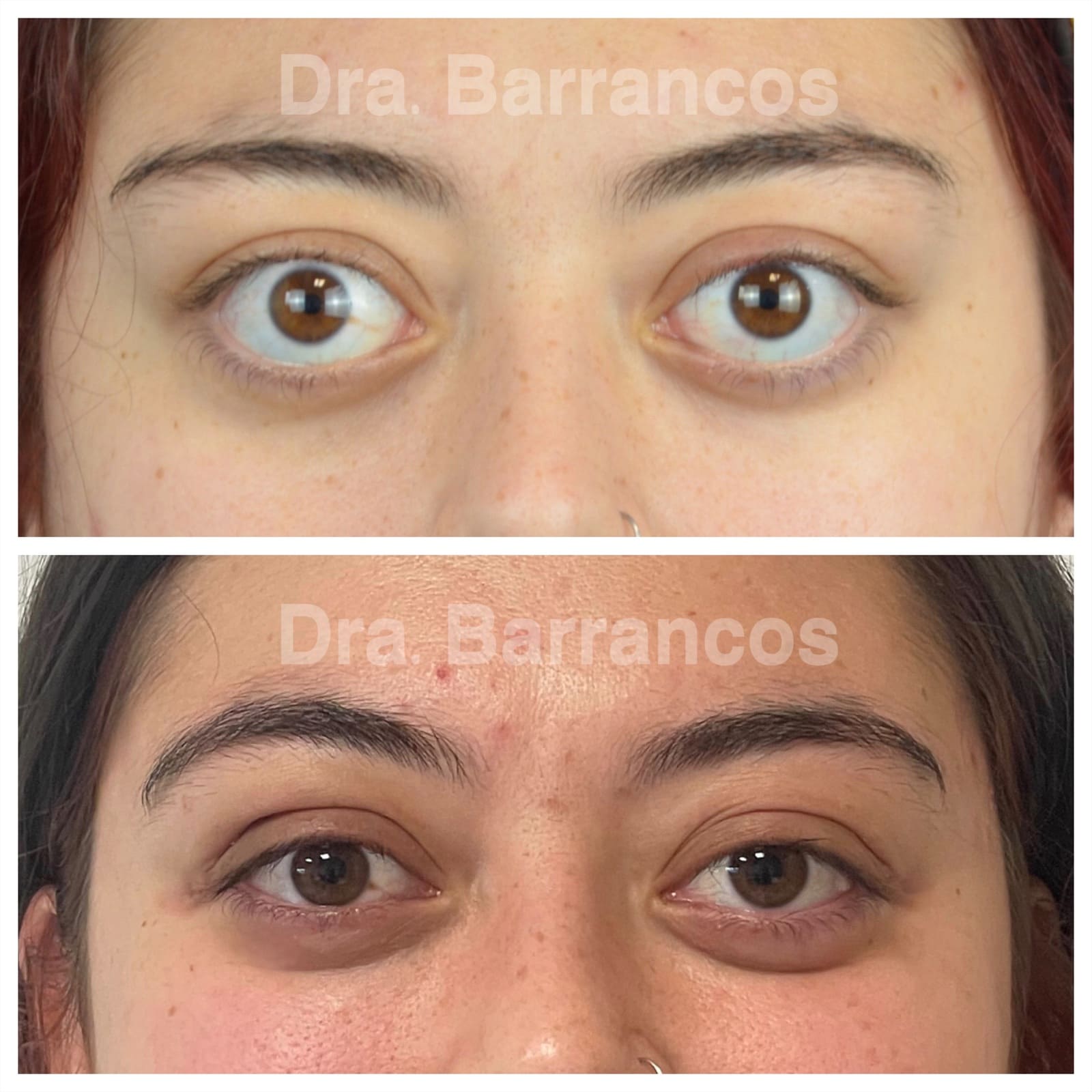 Orbital decompression and eyelid surgery
