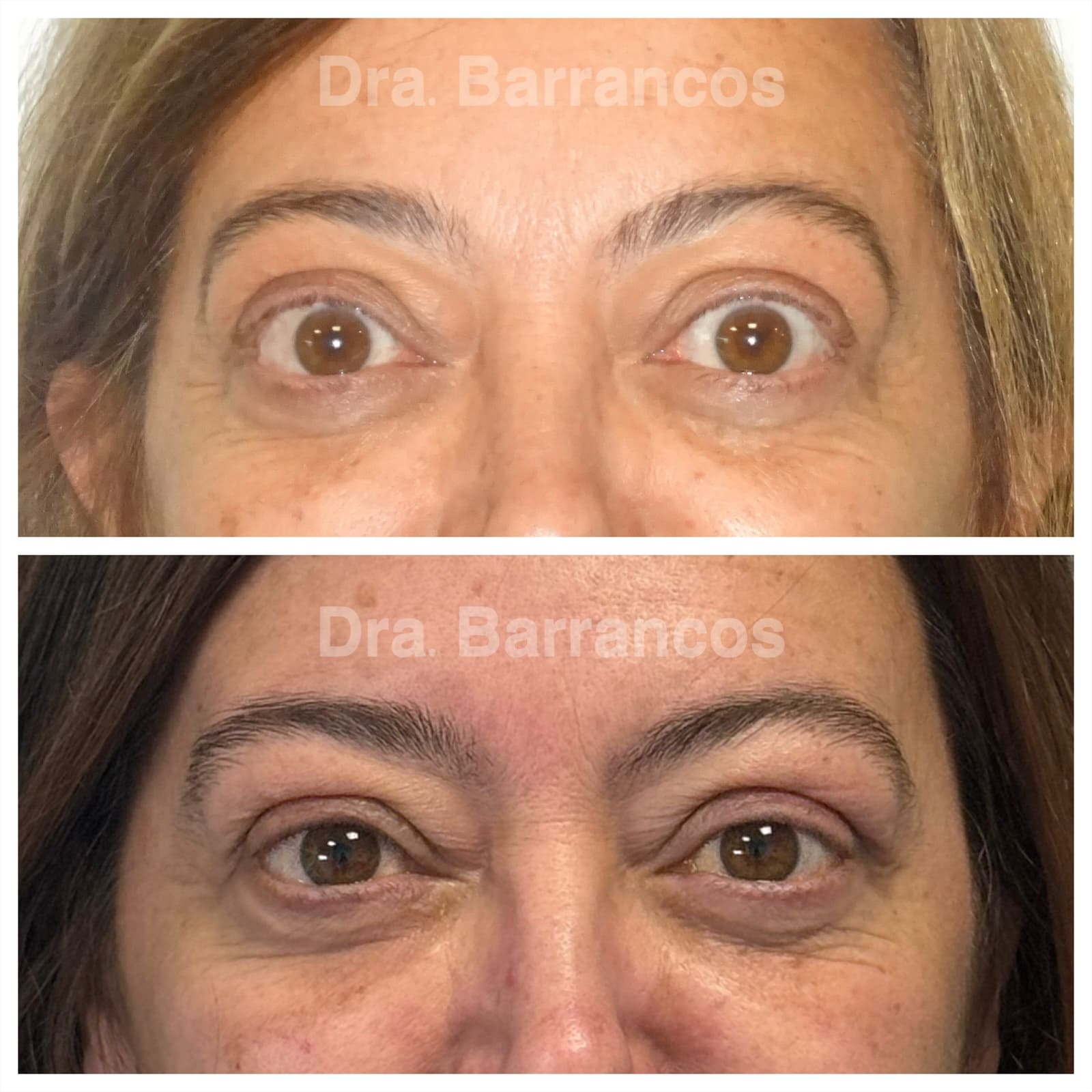 Orbital decompression and eyelid surgery