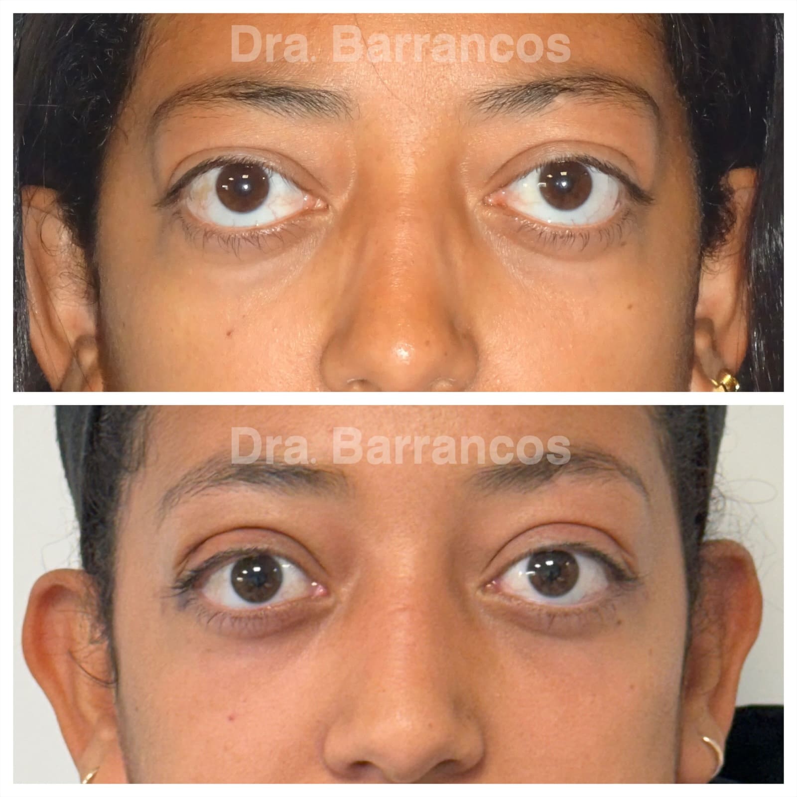 Orbital decompression and eyelid surgery