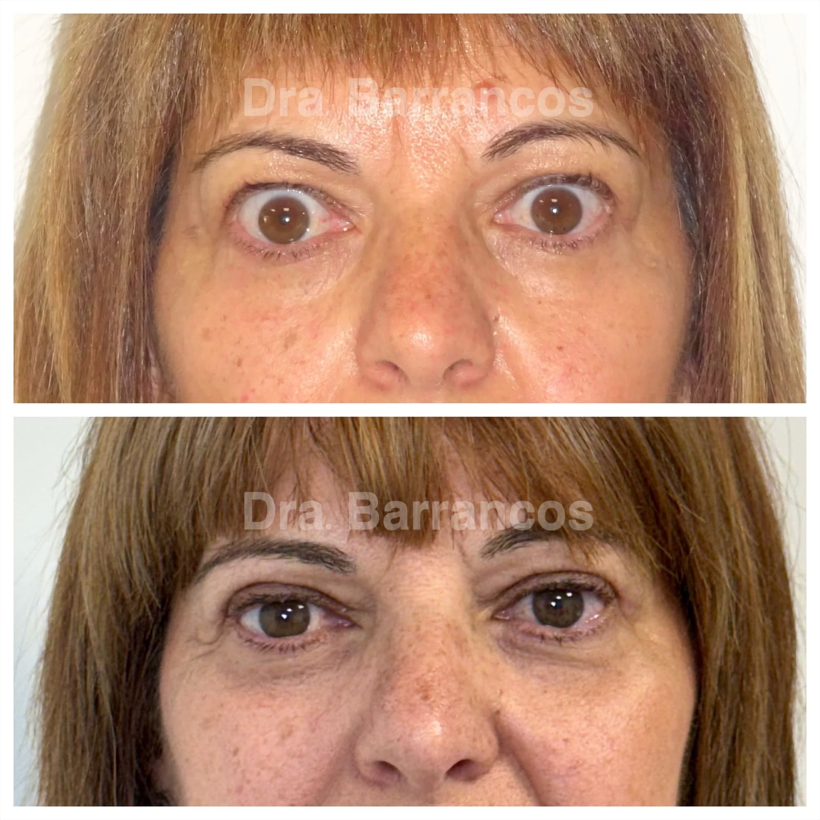 Orbital decompression and eyelid surgery