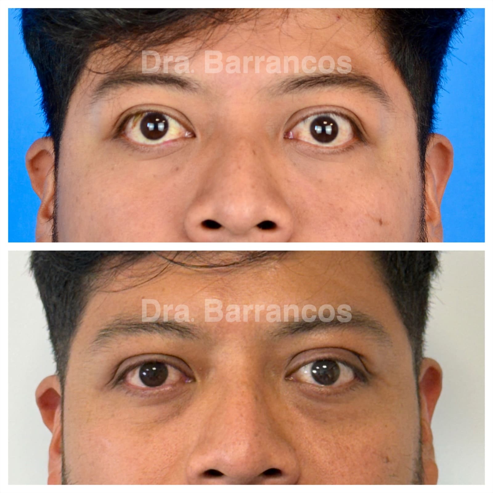 Orbital decompression and eyelid surgery