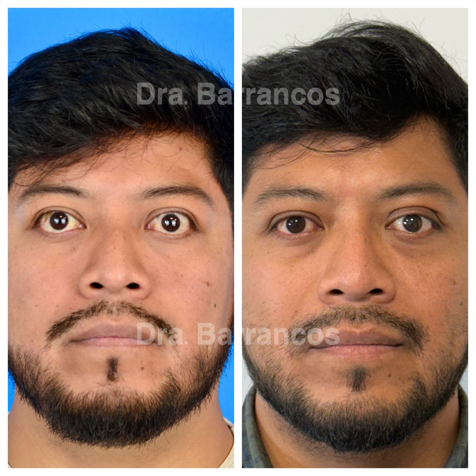 Orbital decompression and eyelid surgery