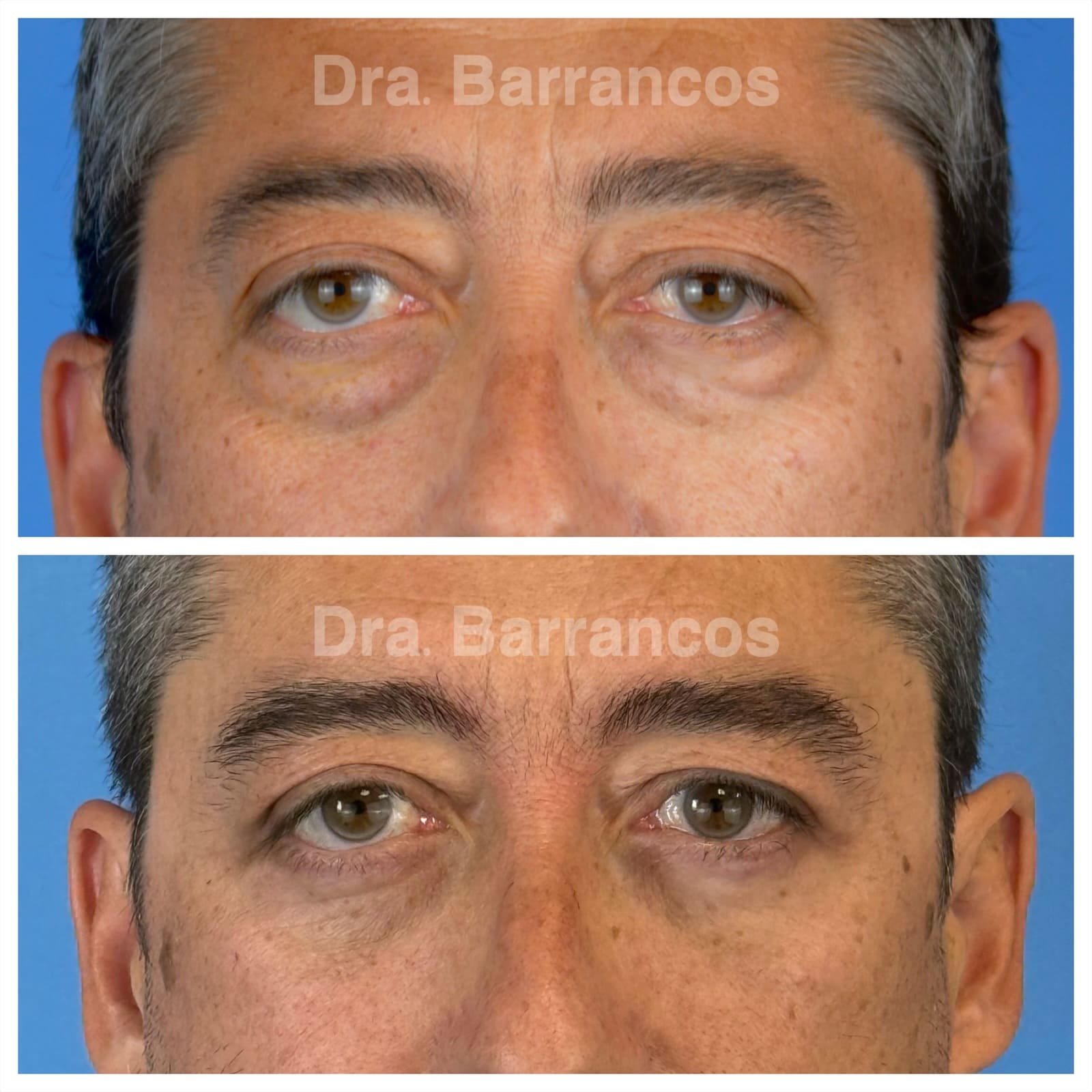 Orbital decompression and eyelid surgery