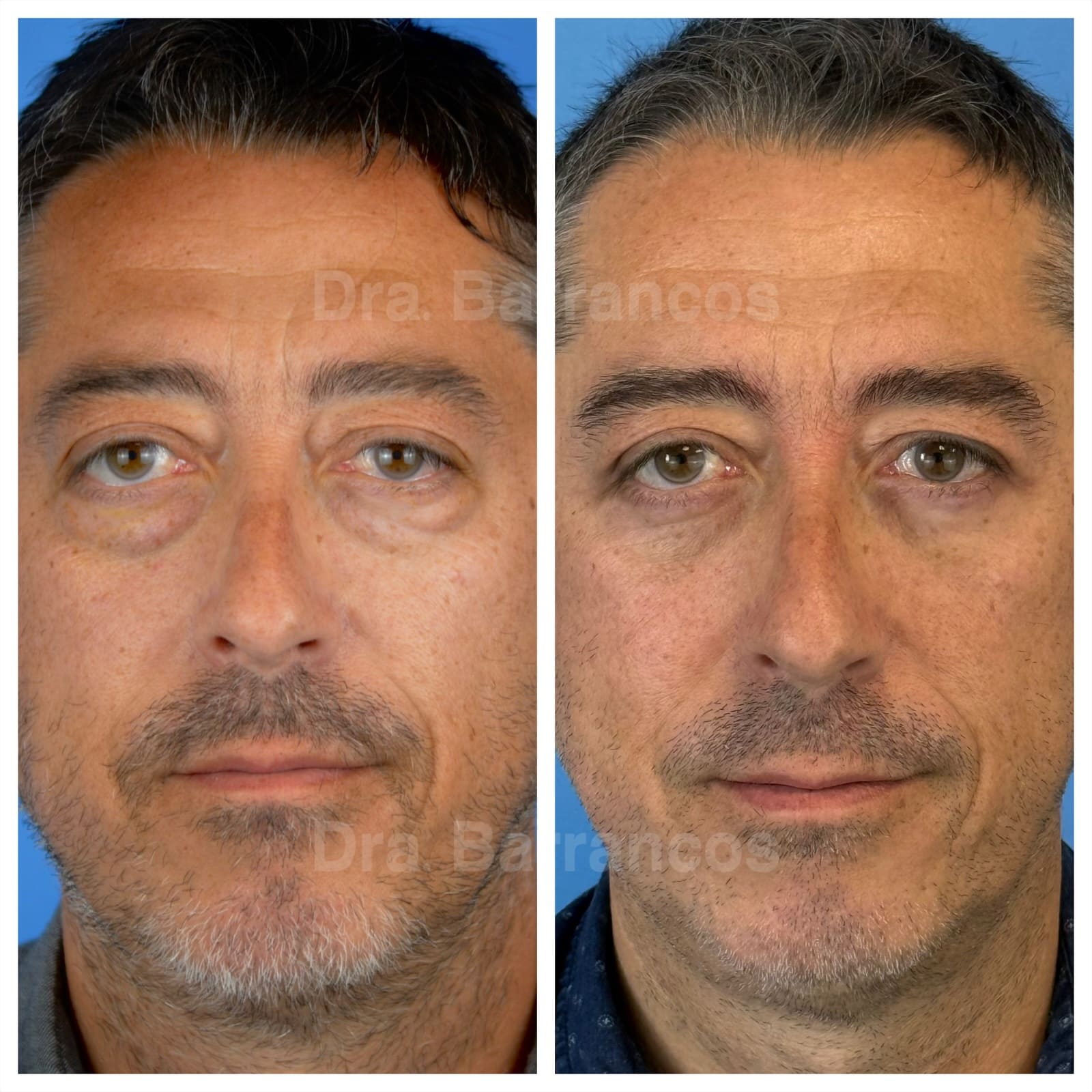 Orbital decompression and eyelid surgery