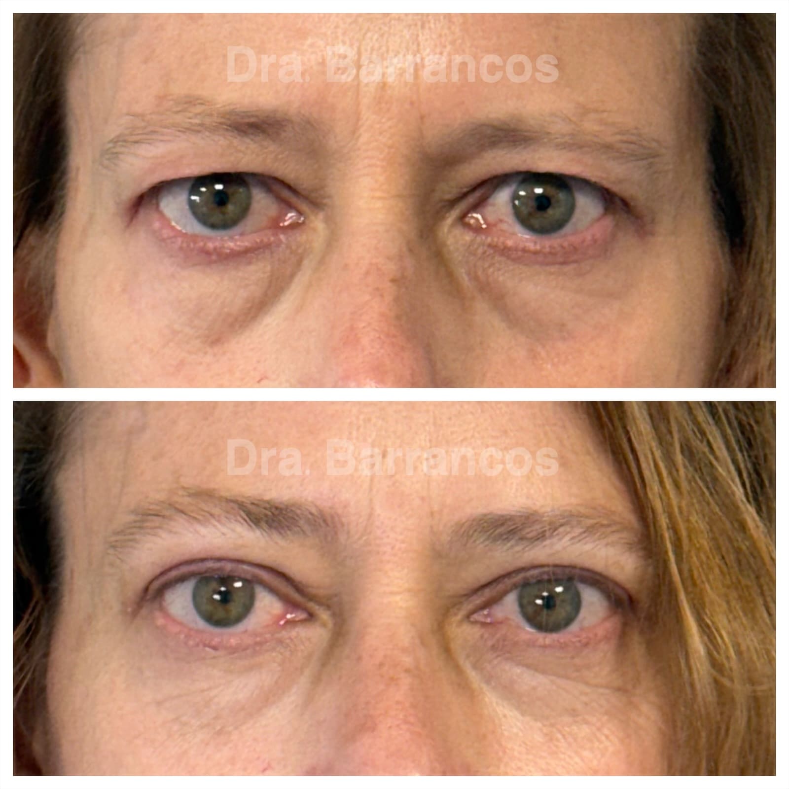 Orbital decompression and eyelid surgery