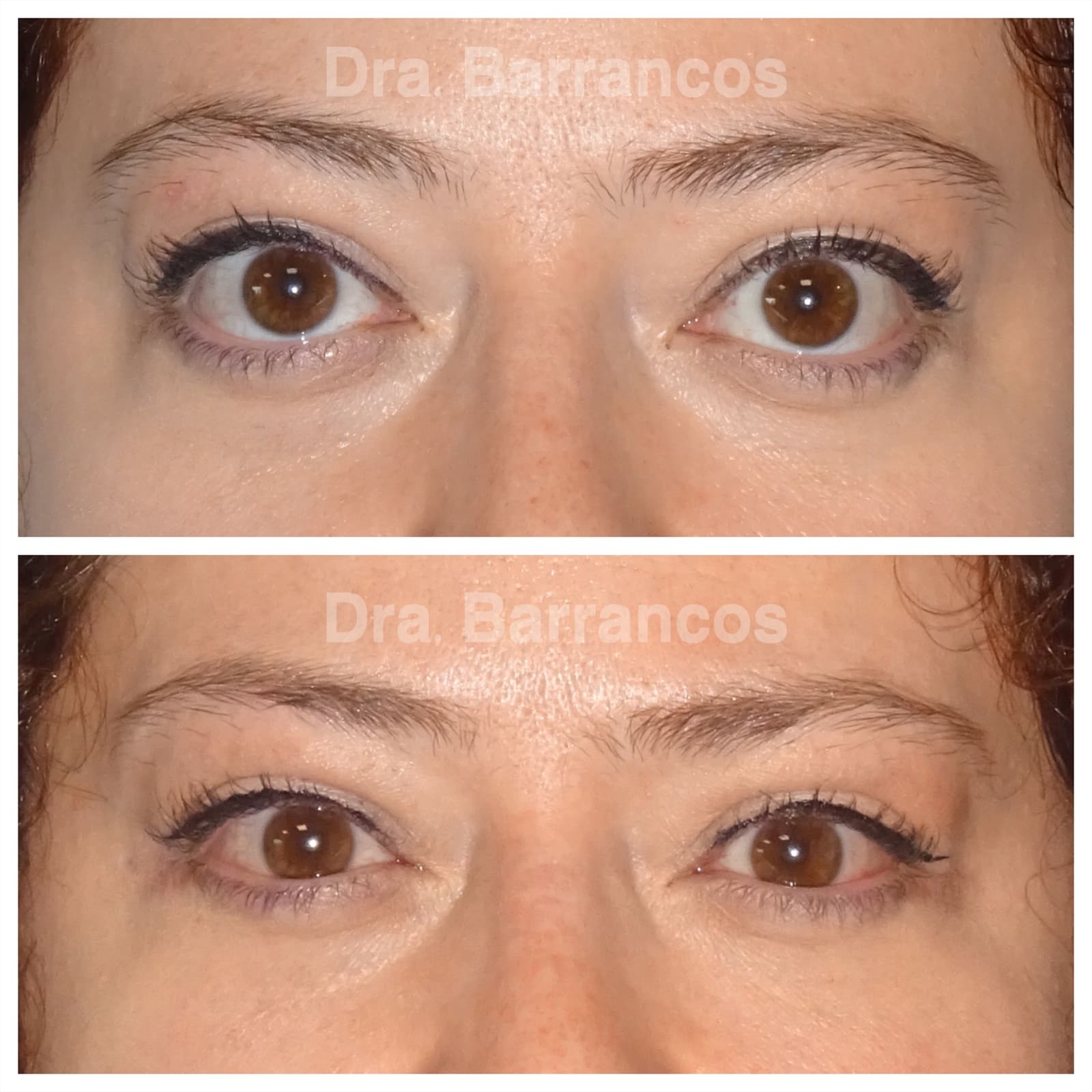 Orbital decompression and eyelid surgery