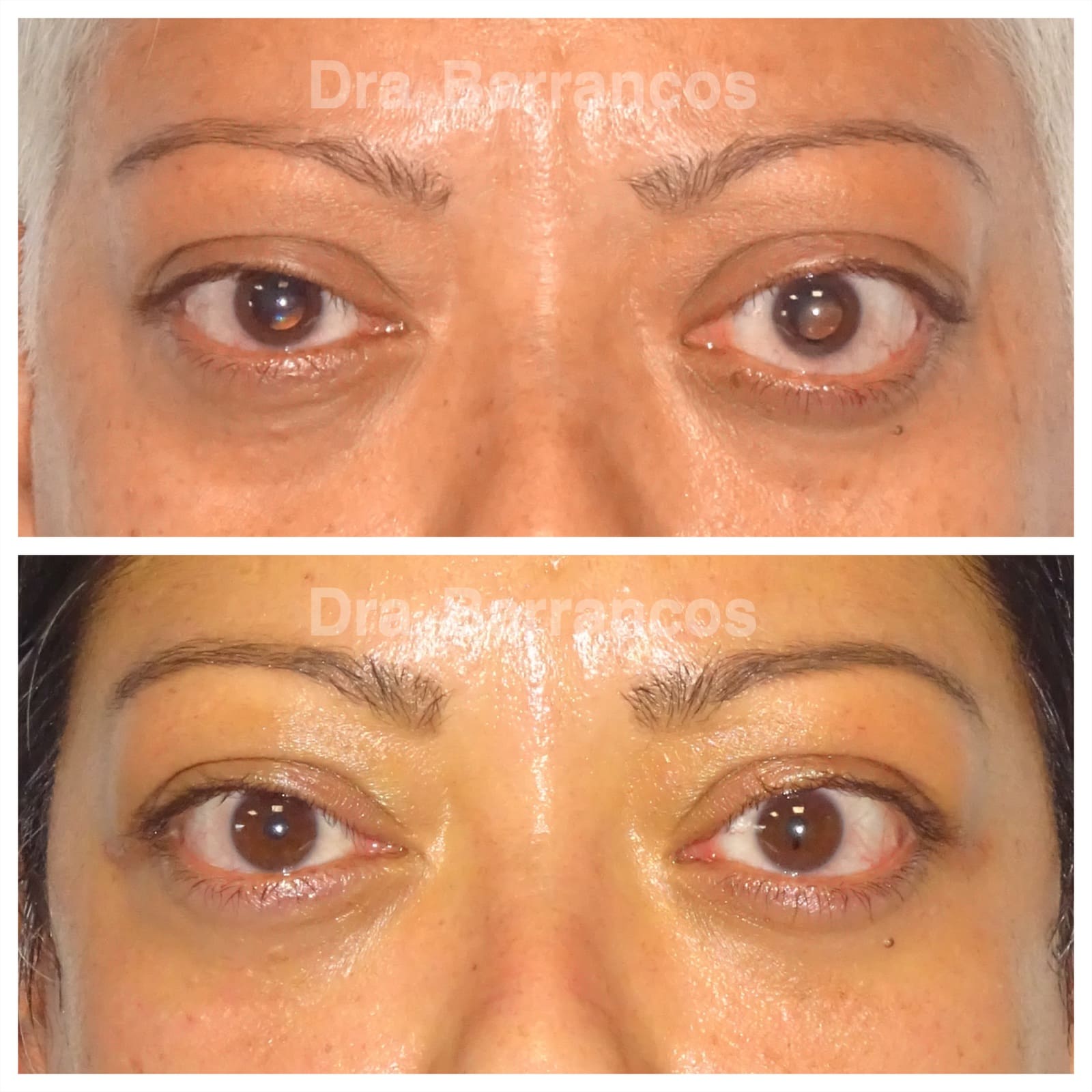 Orbital decompression and eyelid surgery