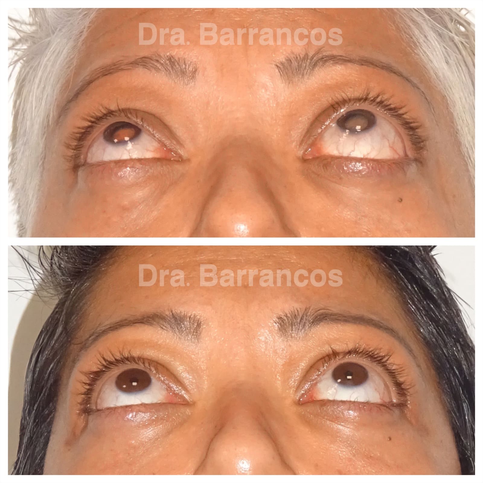Orbital decompression and eyelid surgery