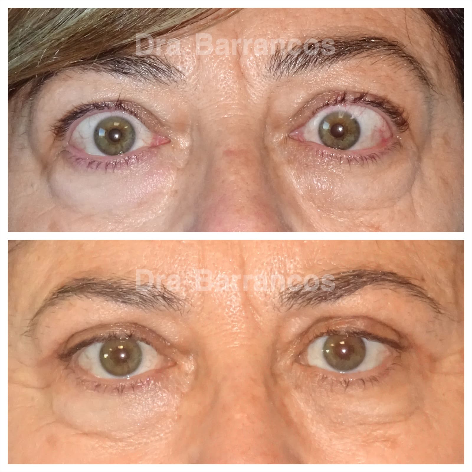 Orbital decompression and eyelid surgery