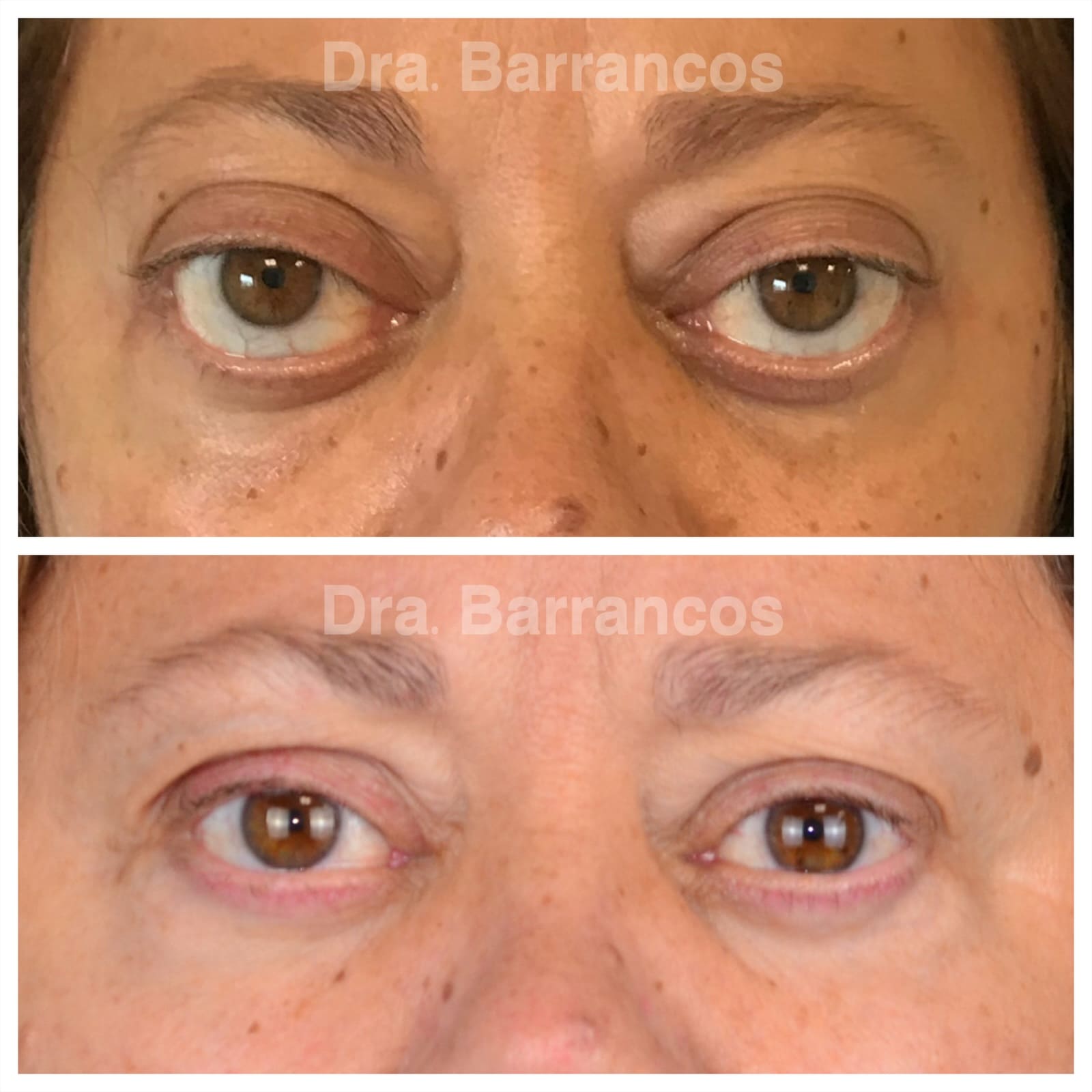 Orbital decompression and eyelid surgery