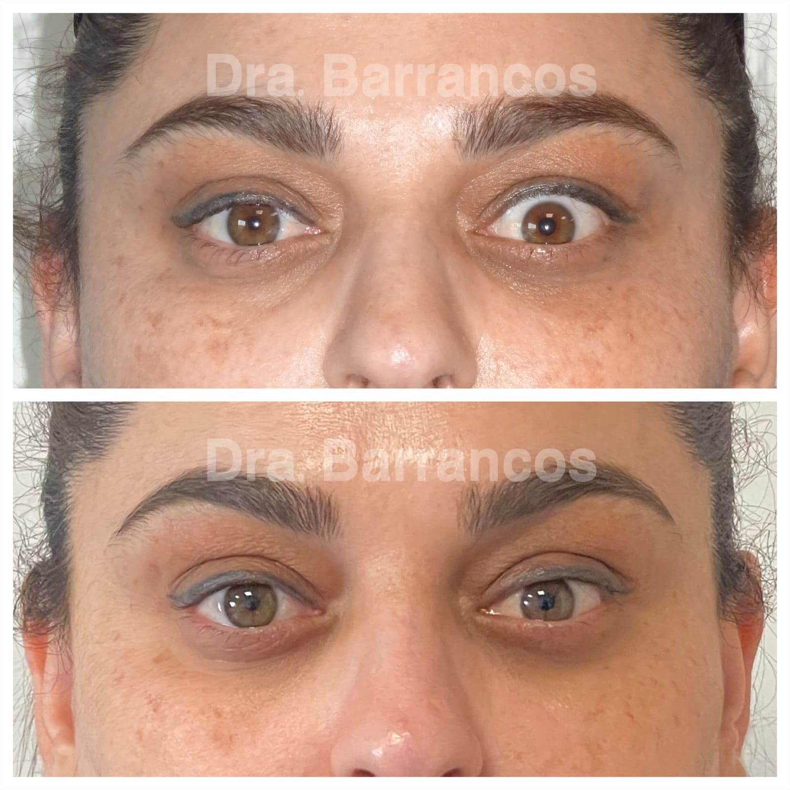 Orbital decompression and eyelid surgery