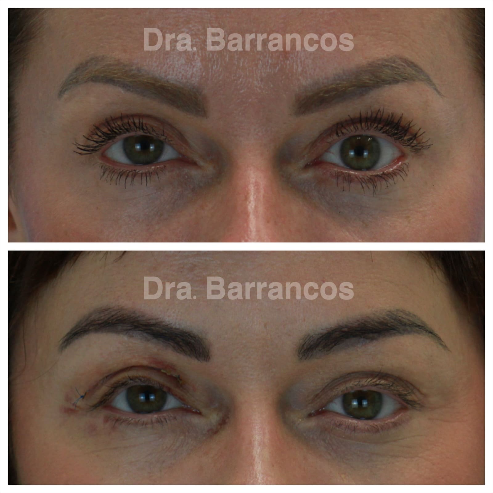 Orbital decompression and eyelid surgery
