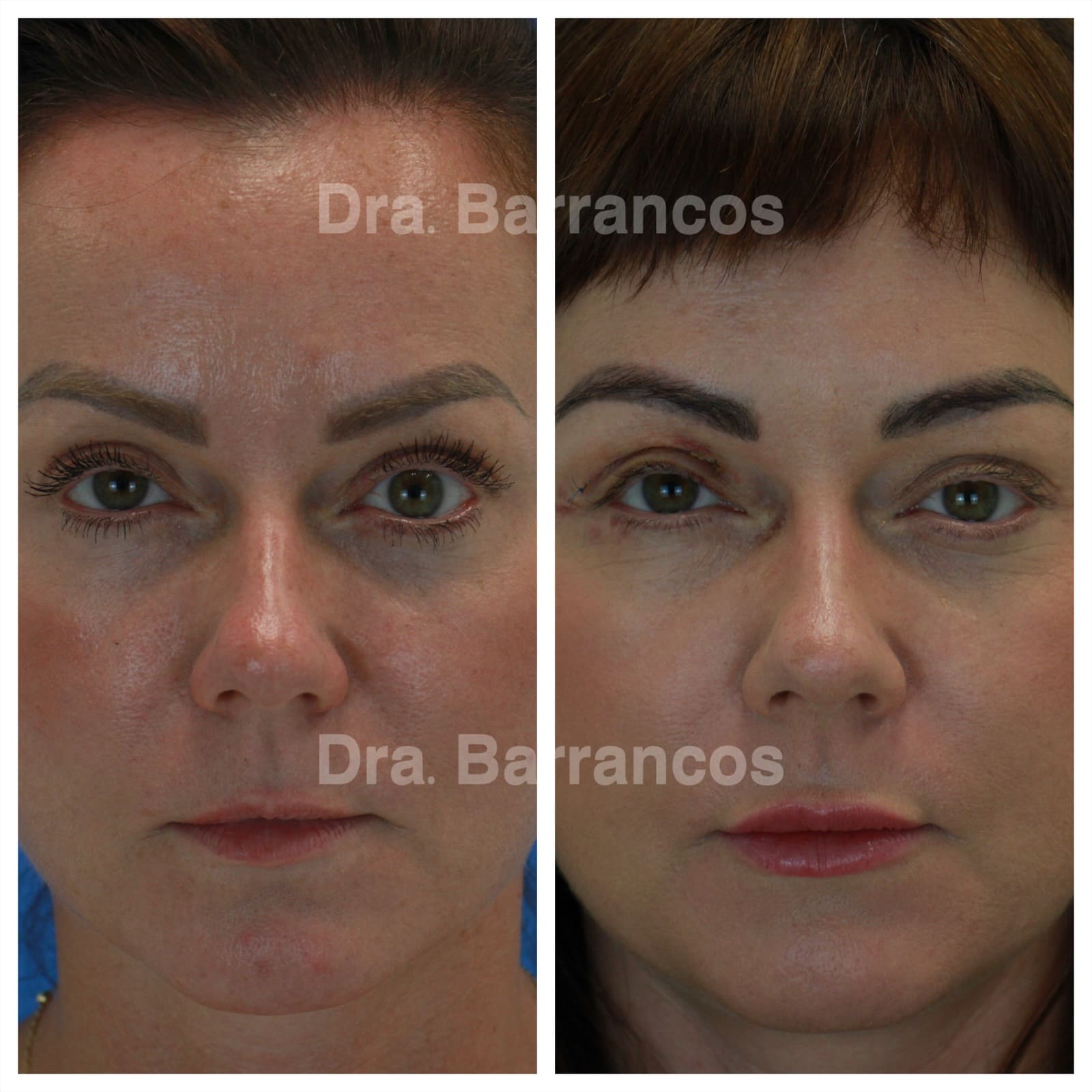 Orbital decompression and eyelid surgery