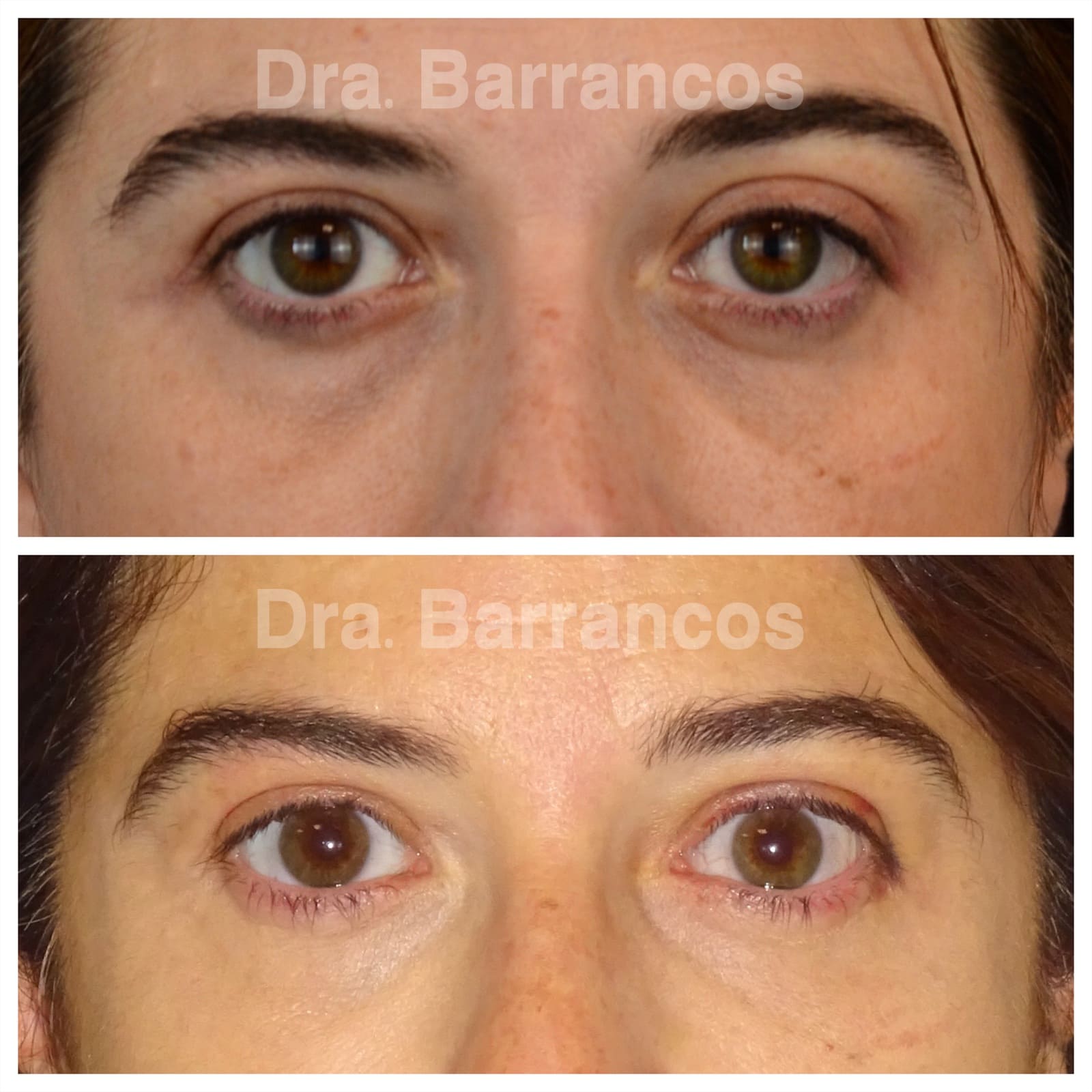 Orbital decompression and eyelid surgery