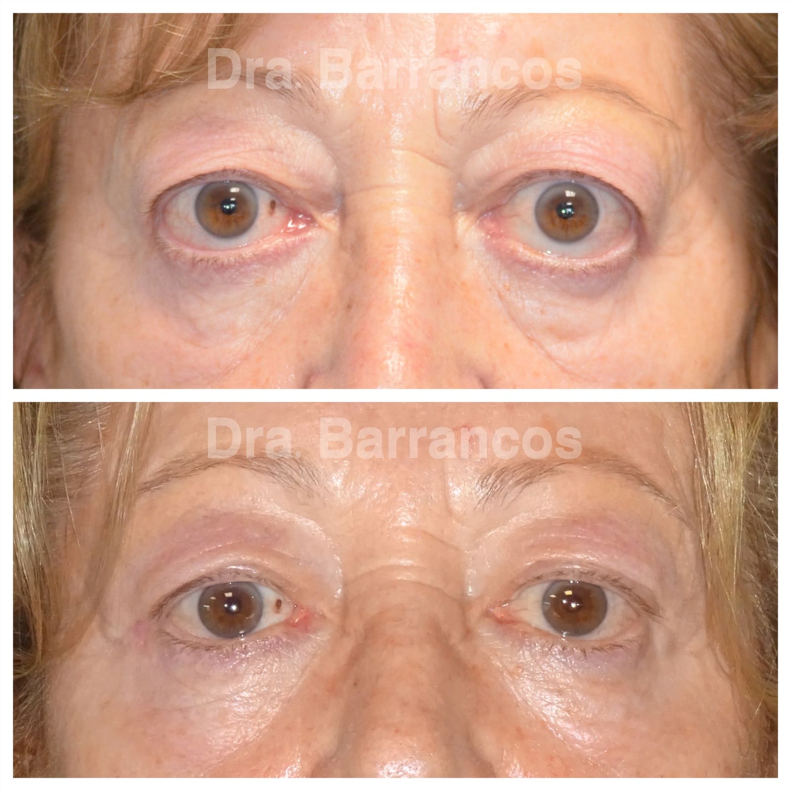 Orbital decompression and eyelid surgery