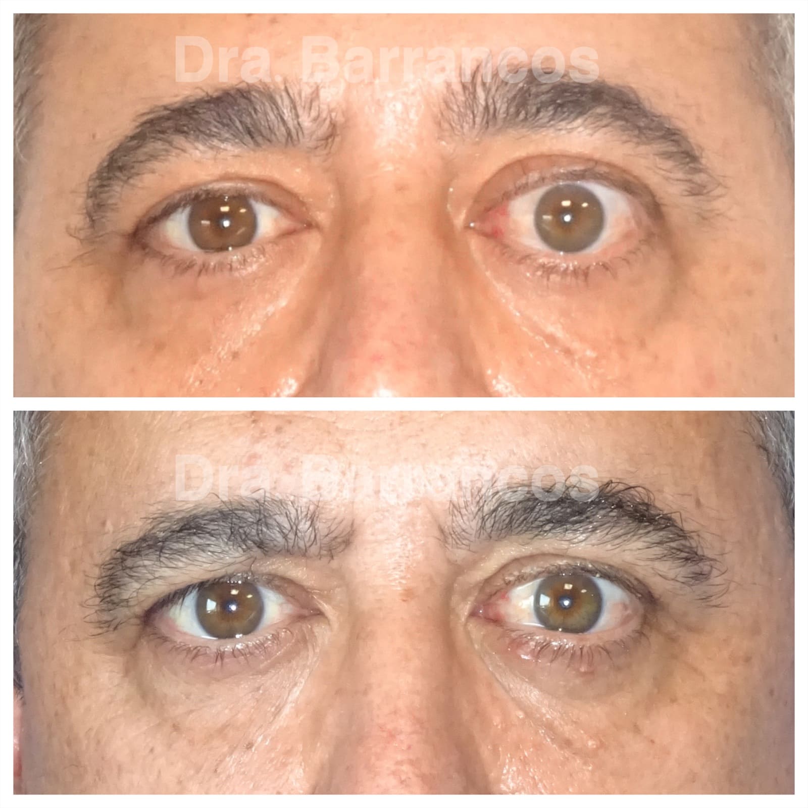 Orbital decompression and eyelid surgery