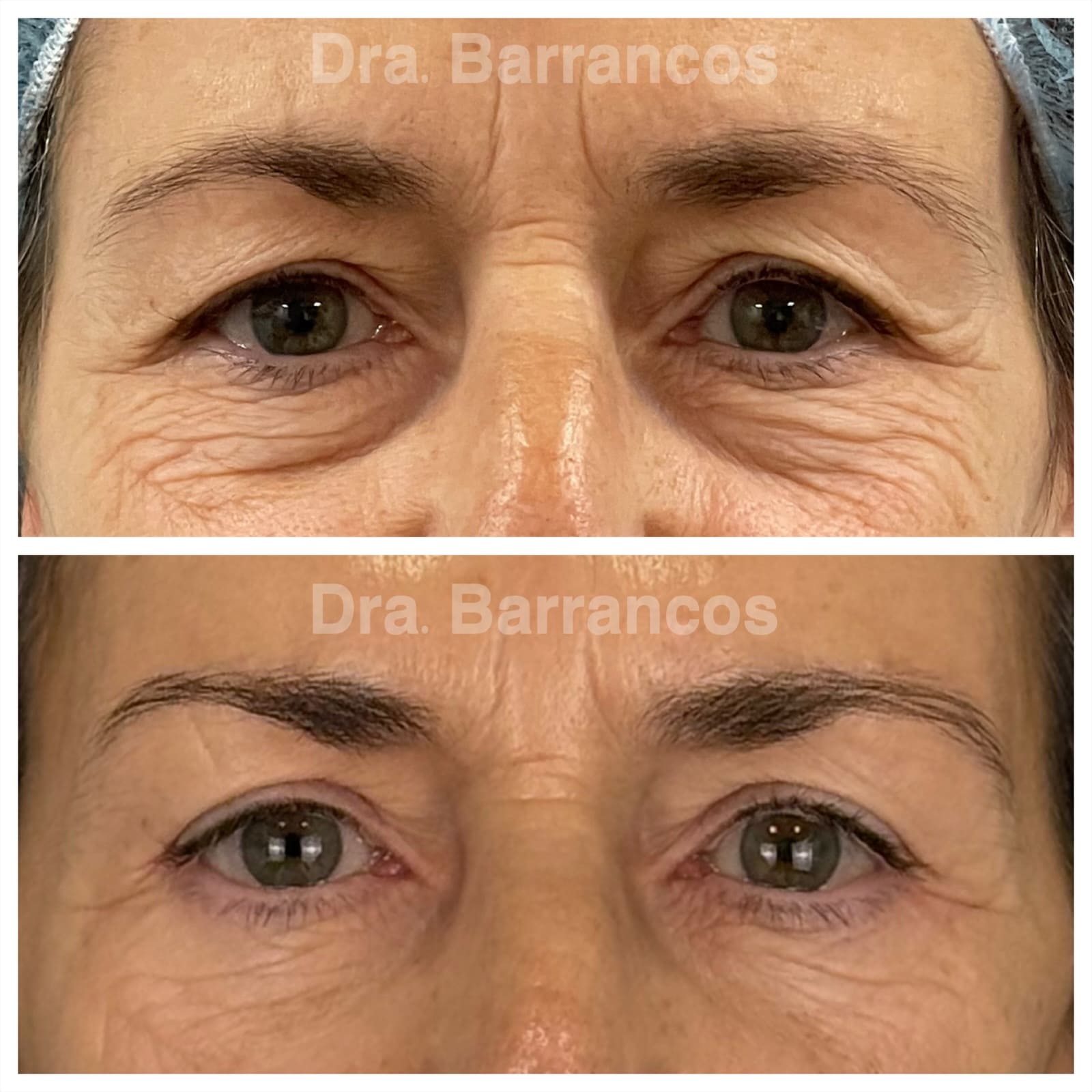 Complete blepharoplasty
