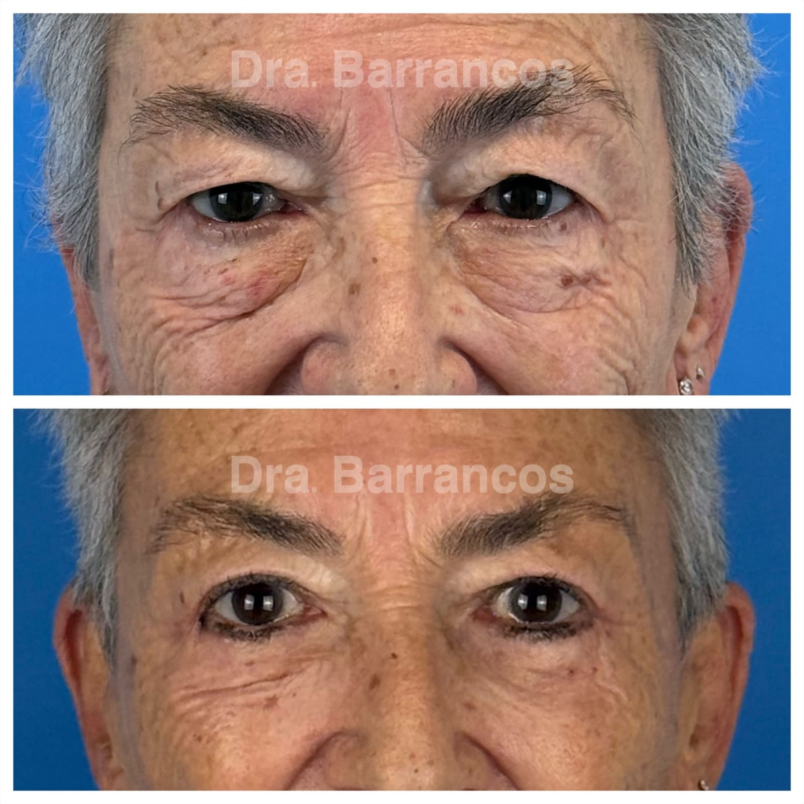 Complete blepharoplasty