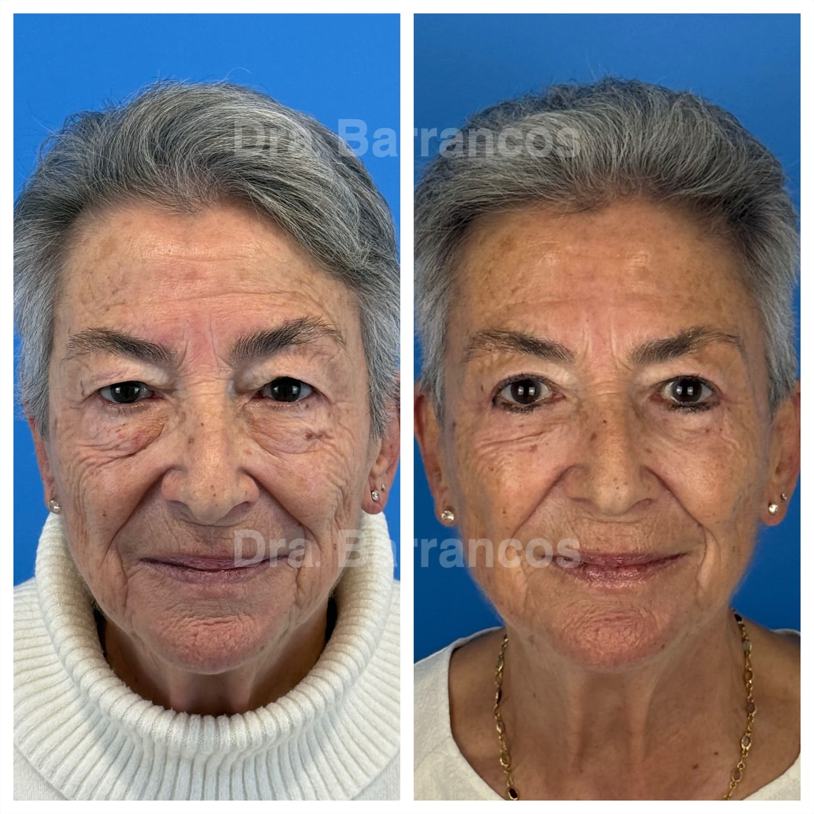 Complete blepharoplasty