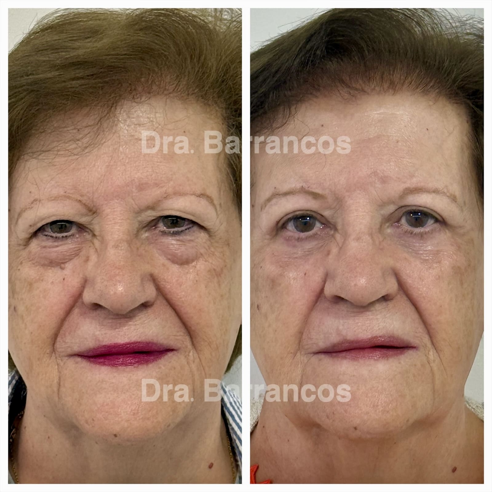 Complete blepharoplasty