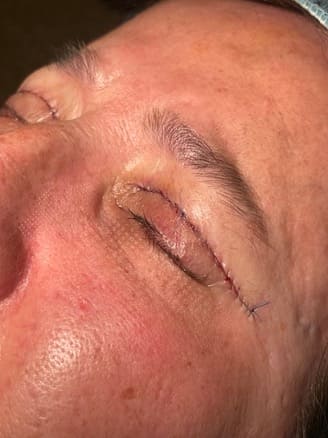 Resurfacing and blepharoplasty