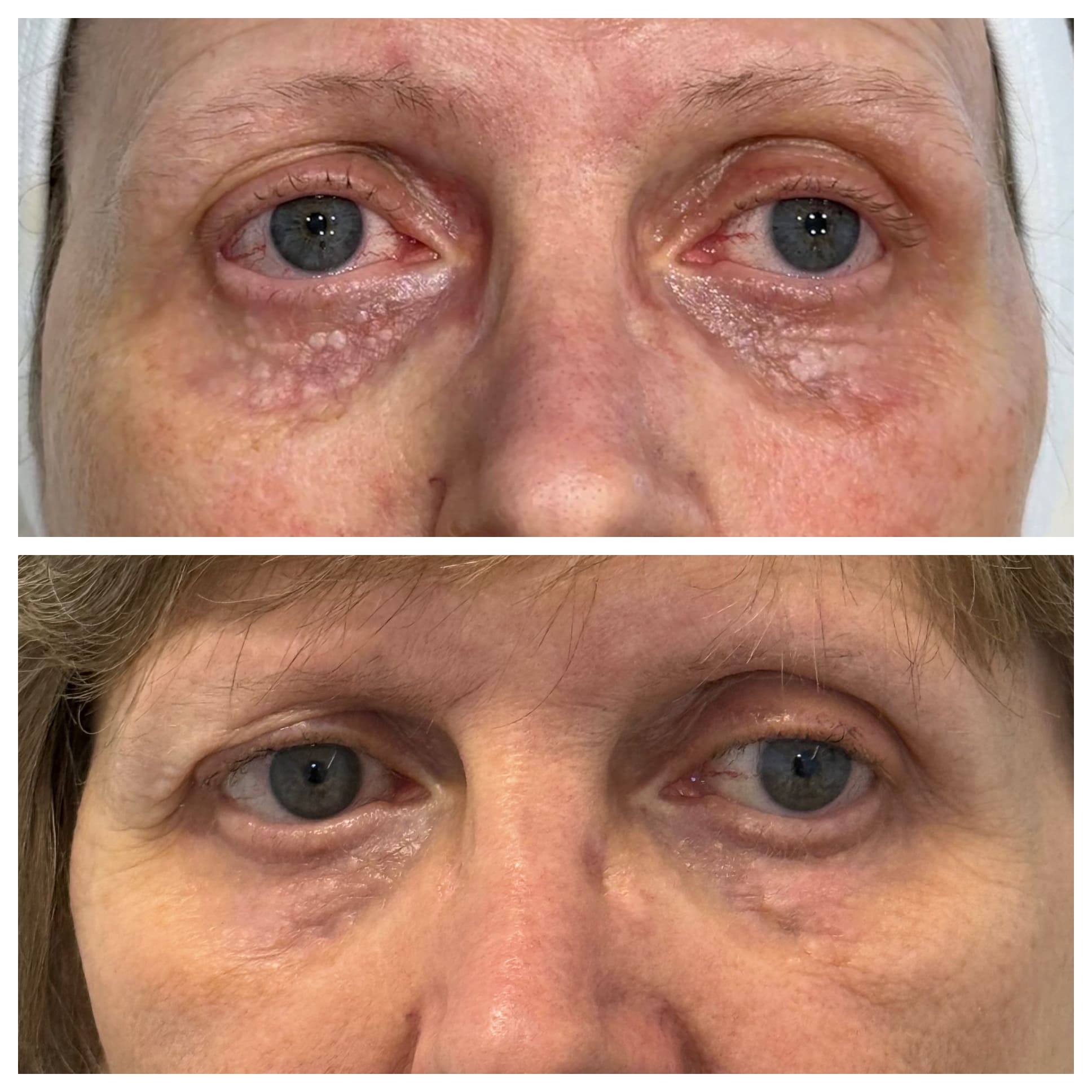 Periocular syringomas
